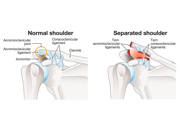 ACJ Reconstruction Surgery Expert Treatment By Mr Singh