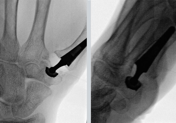 Thumb CMC Joint Replacement Surgery London Mr Jagwant Singh