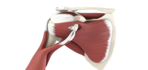 Bone Block Shoulder Surgery 