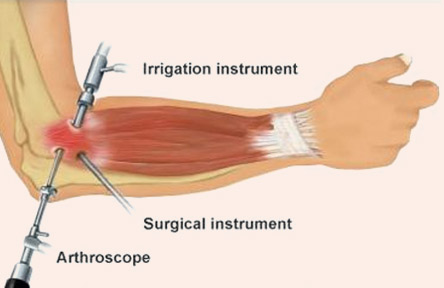 ch elbow arthroscopy particularly1.00