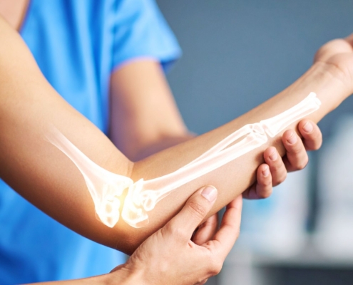 What is the Recovery Time for a Fractured Elbow